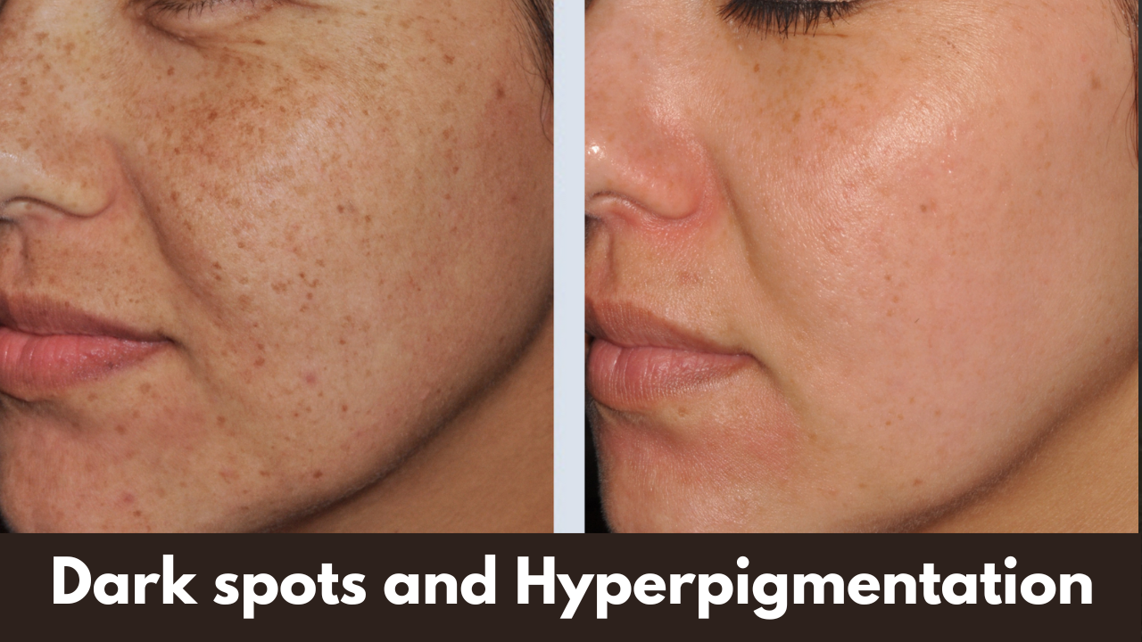 How to get Rid of Dark Spots and Hyperpigmentation in 5 Simple Ways